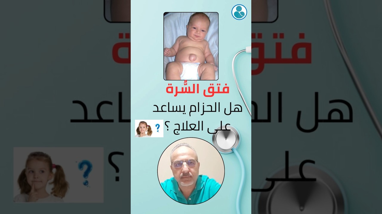 فتق السرة عند الأطفال/ umbilical hernia