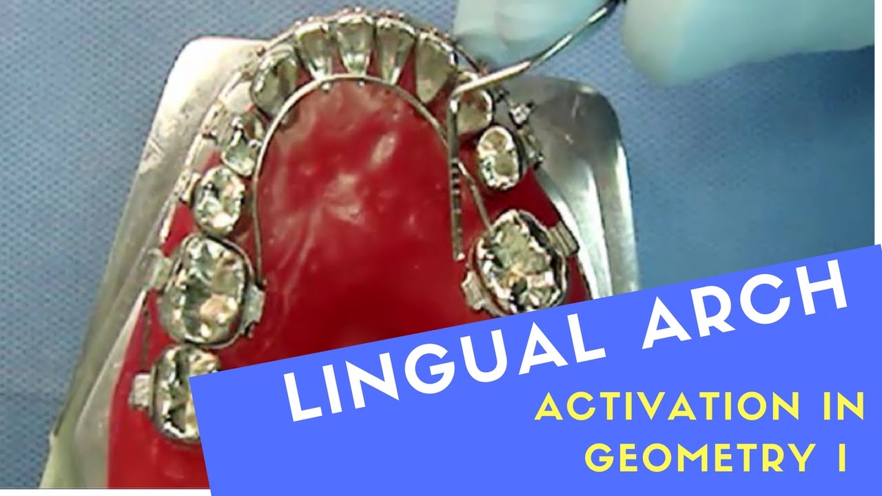 LINGUAL ARCH ACTIVATED IN GEOMETRY I