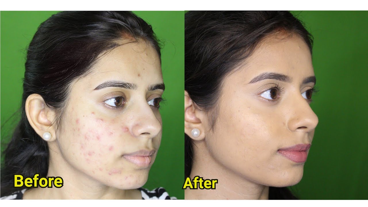 How to cover acne scars with makeup for indian skin | acne prone skin 2018