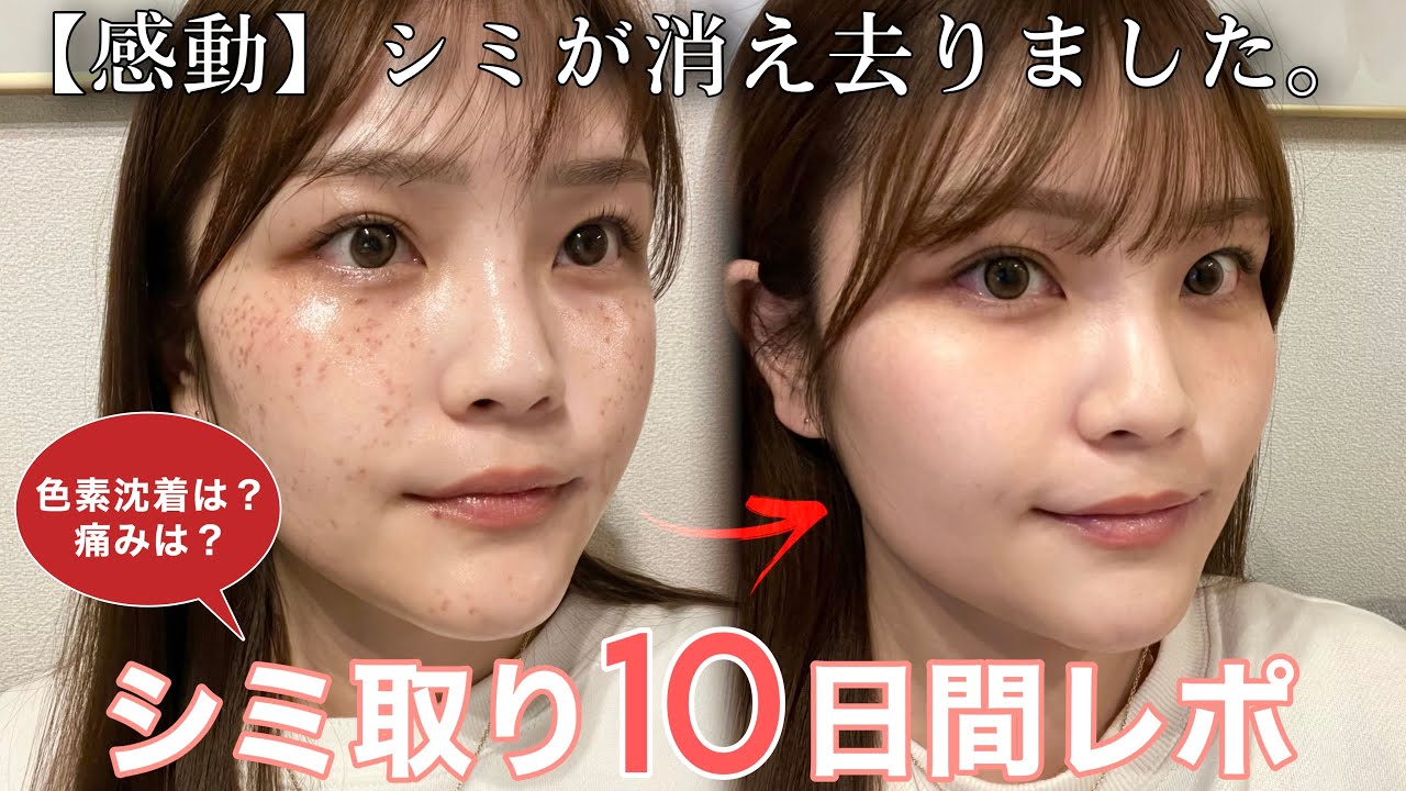 【シミ治療】レーザーでシミそばかすが消えた❕実際かかった費用も❕