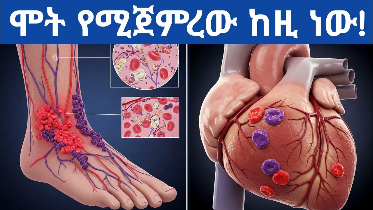 የደም መርጋት ምንድን ነው? መንስኤዎች፣ምልክቶች፣አደጋውና የደም መርጋትን የሚከላከሉ ፍራፍሬዎች| foods dissolve blood clots instantly