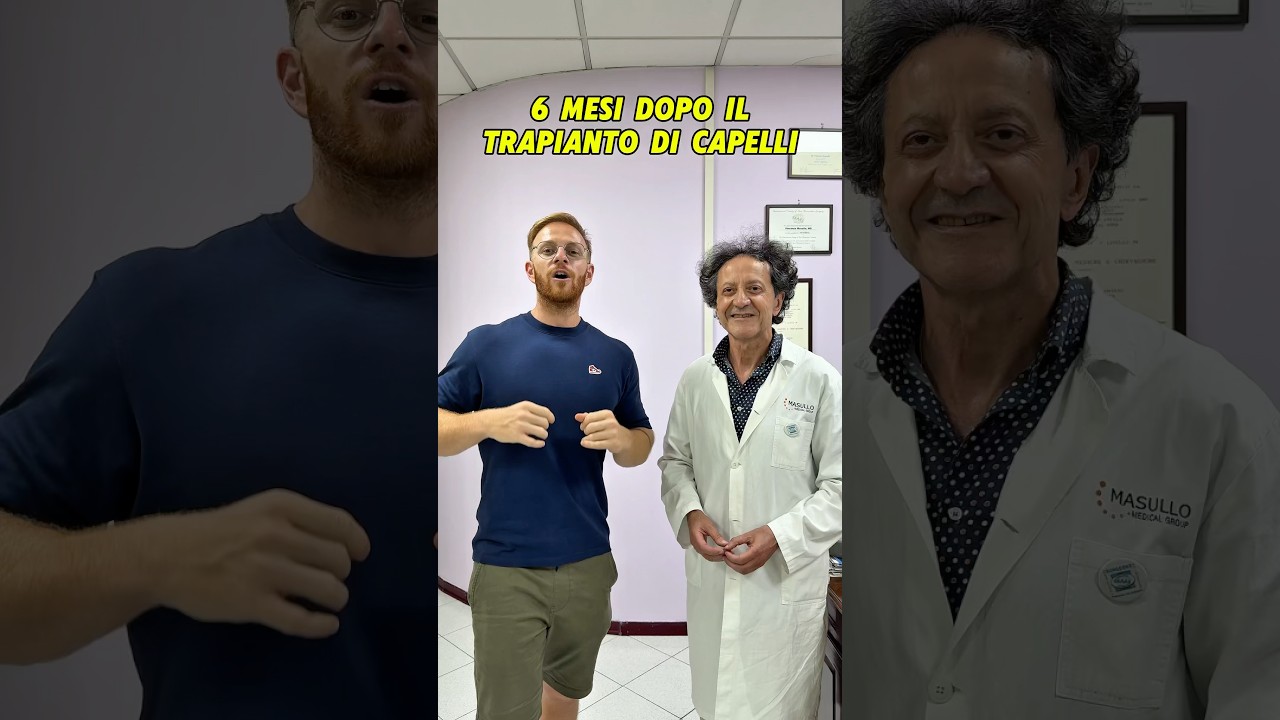 Vi mostro i risultati a sei mesi dal secondo trapianto di capelli in Italia❤️