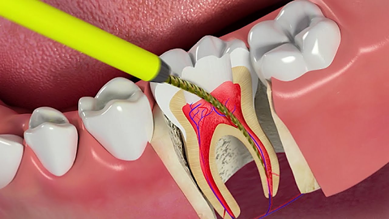 Điều trị viêm chân răng - viêm tủy răng