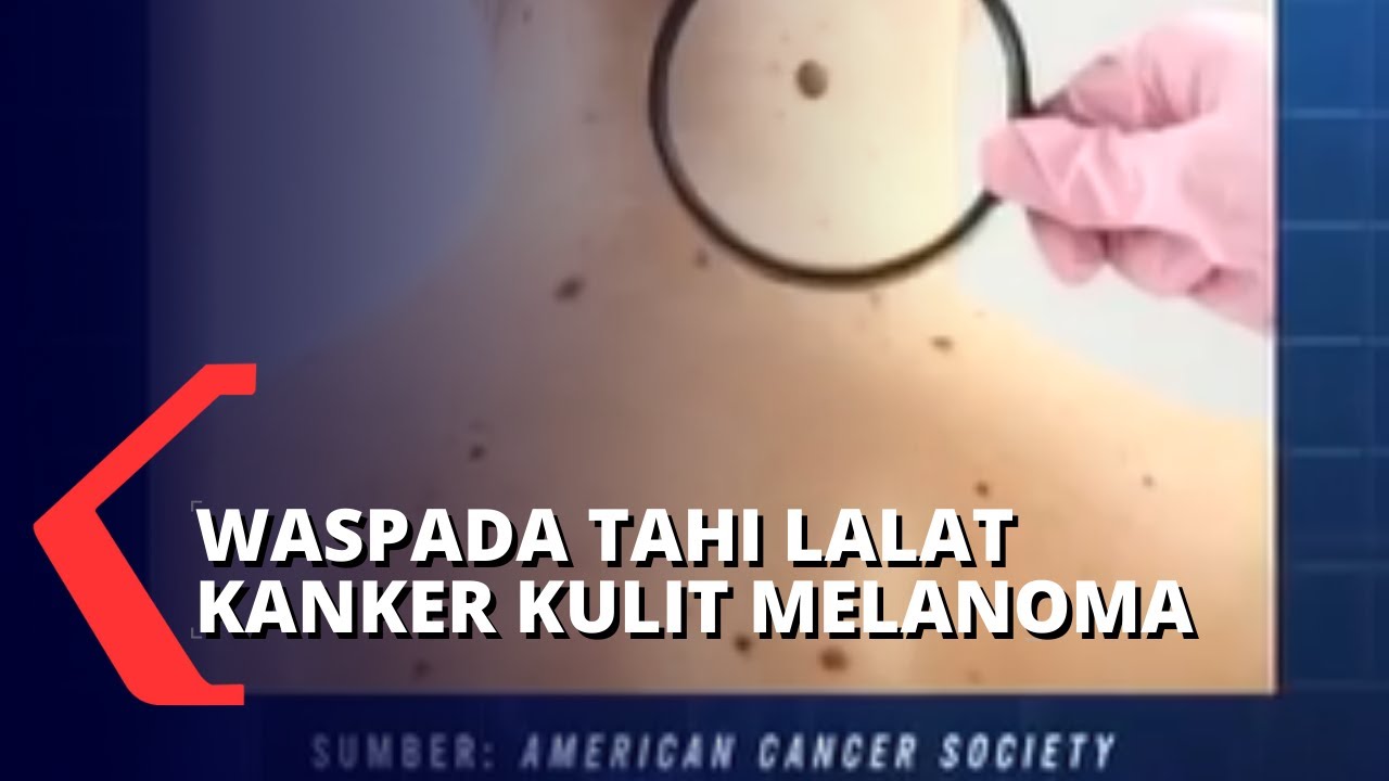 Dampak Fatal Kanker Kulit Melanoma, Cegah Mulai Sekarang!