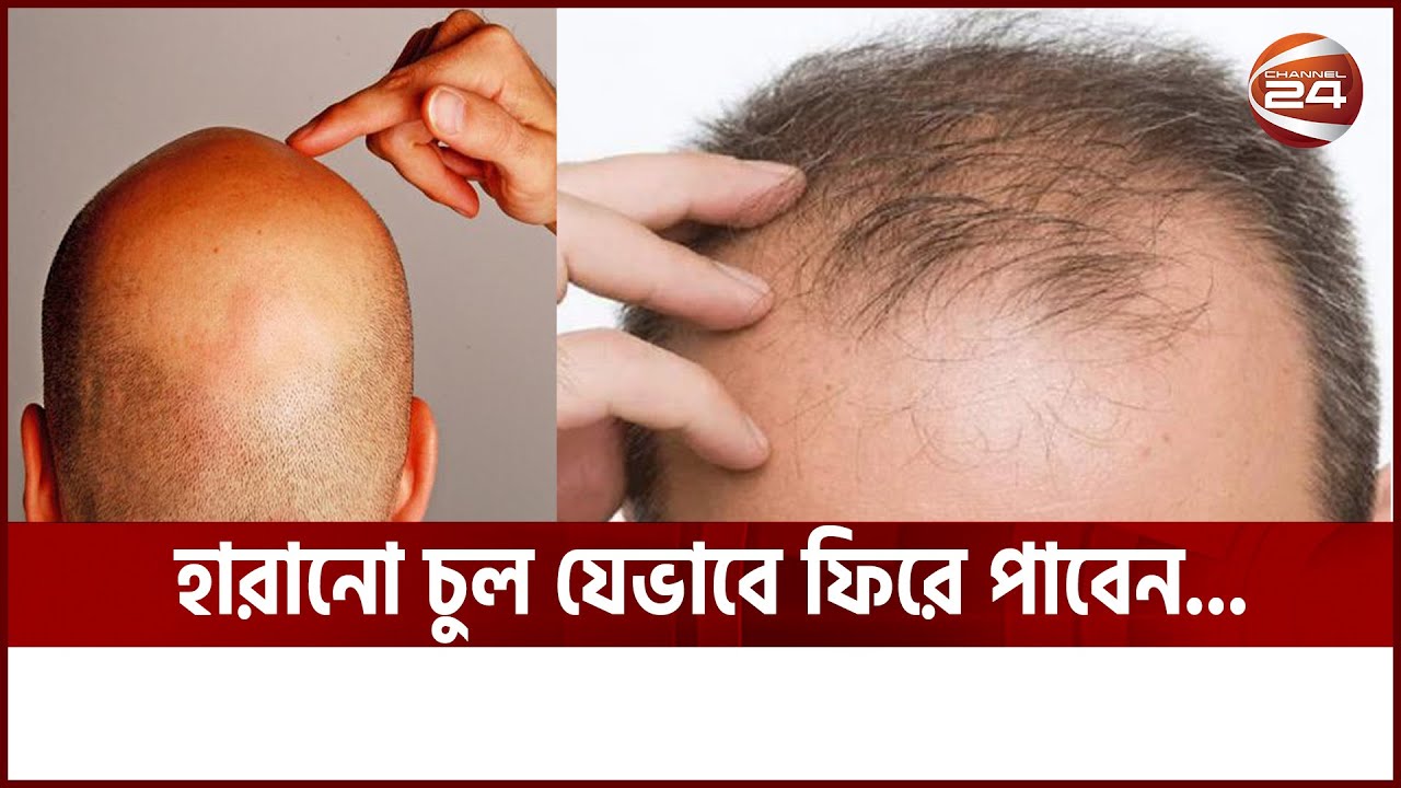 সার্জারির ছাড়াই টাকের স্থায়ী সমাধান  || Hair Transplant || Channel24