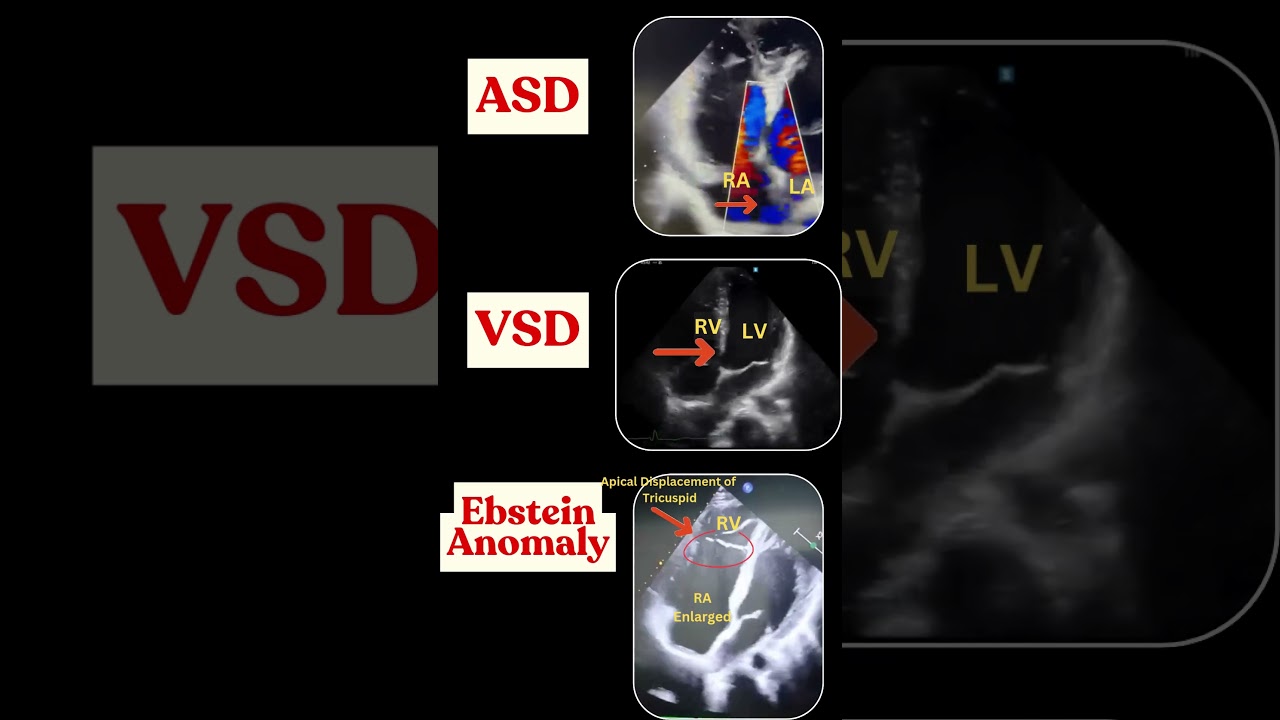 Congenital Heart Defects on Echo: ASD, VSD & More! #congenitalheartdisease