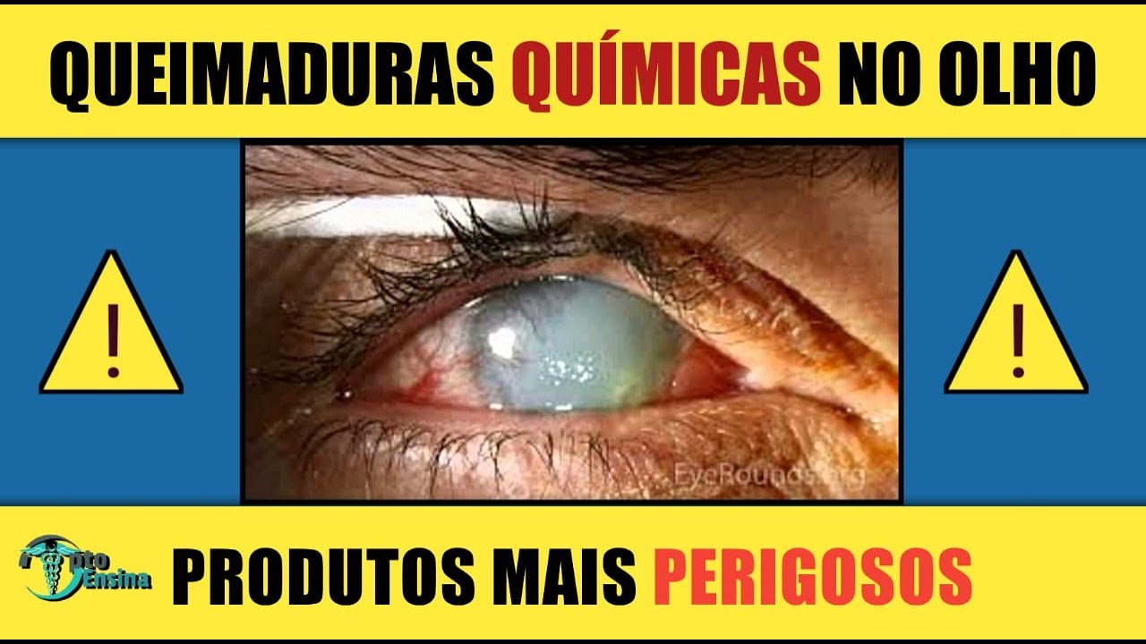 O QUE FAZER APÓS UMA QUEIMADURA NO OLHO?#dicas_para_olhos #optoensina