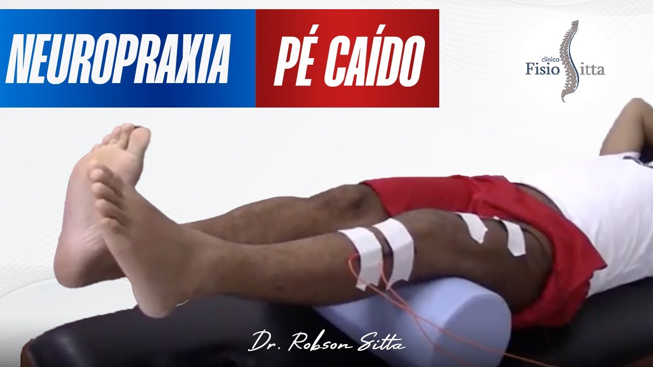 LESÃO do NERVO FIBULAR COMUM e TIBIAL NEUROPRAXIA PÉ CAÍDO - Fisioterapia Dr. Robson Sitta