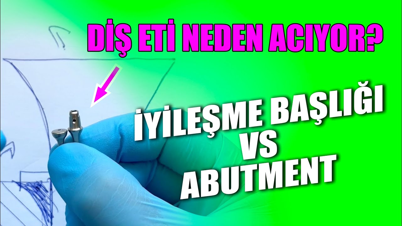 İyileşme Başlığı ve Abutment Seçimi Nasıl Yapılır? İmplant Üstü Protez Ara Parçaları