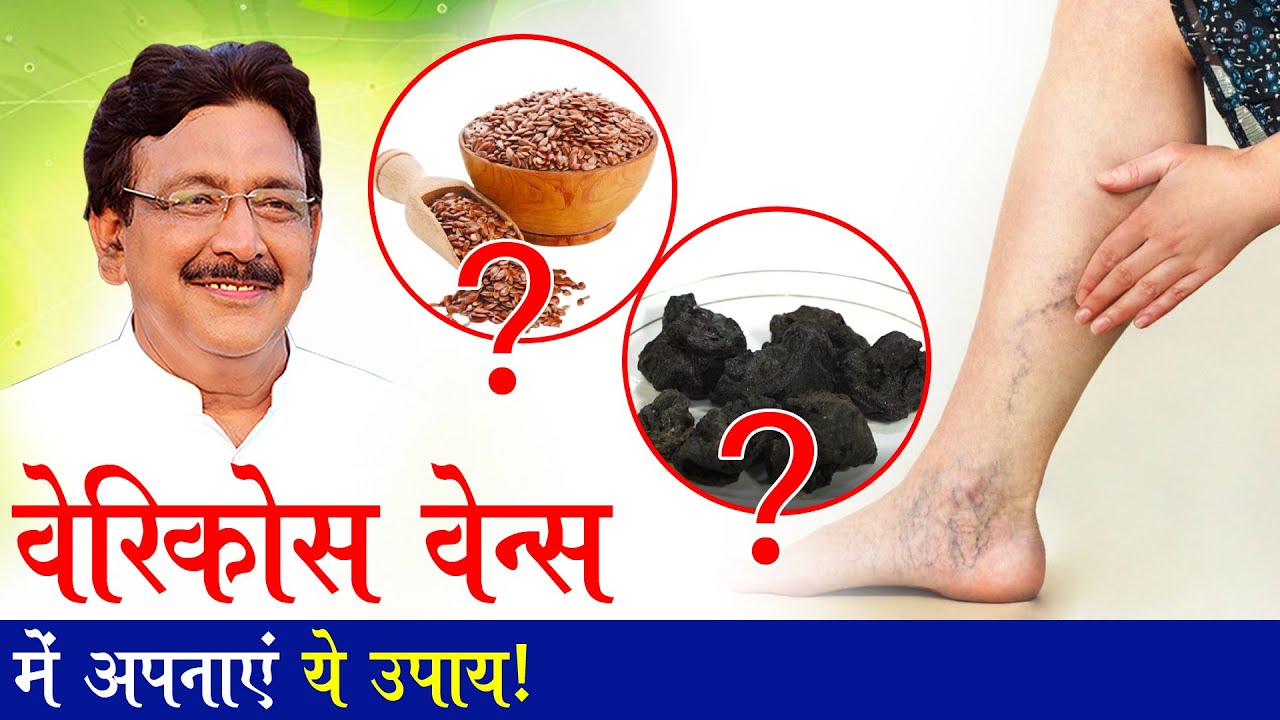 वैरिकोज वेन्स में इस आयुर्वेदिक लेप से होगा फायदा, जानिए हकीम सुलेमान जी की सलाह !