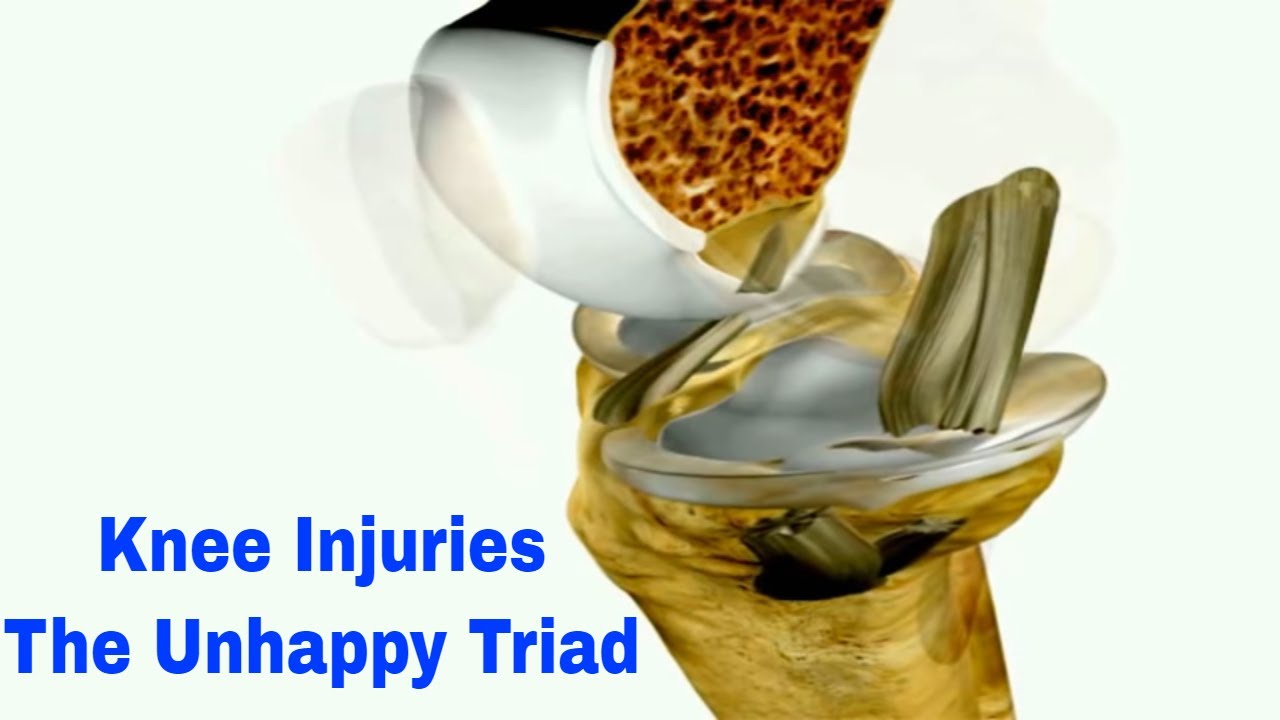 Knee Injuries: Understanding the Unhappy Triad &ndash; ACL, MCL, and Meniscus Tears