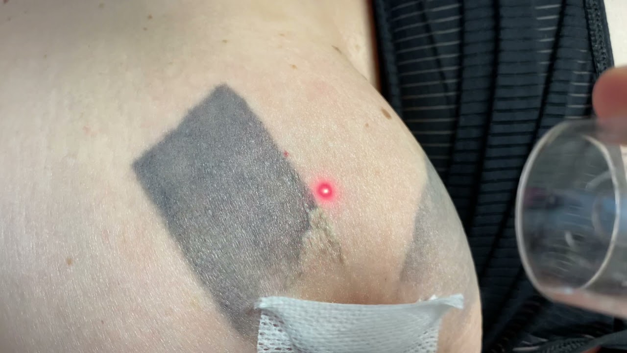 Laser Tattoo Removal of tattoo around the nipple on a woman&rsquo;s breast