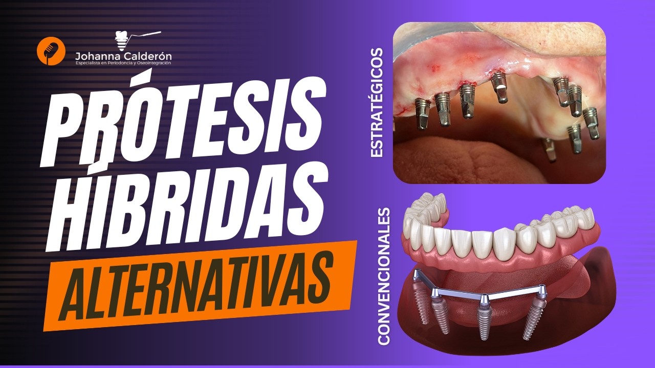 TIPOS DE PRÓTESIS HÍBRIDAS ALL ON 4 EN COLOMBIA | ¿IMPLANTES DENTALES CONVENCIONALES O ESTRATÉGICOS?