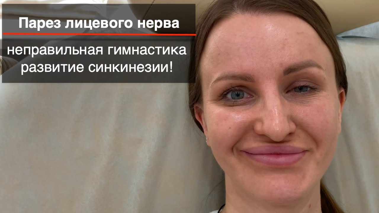 Парез лицевого нерва, неправильная гимнастика, развитие синкинезии!