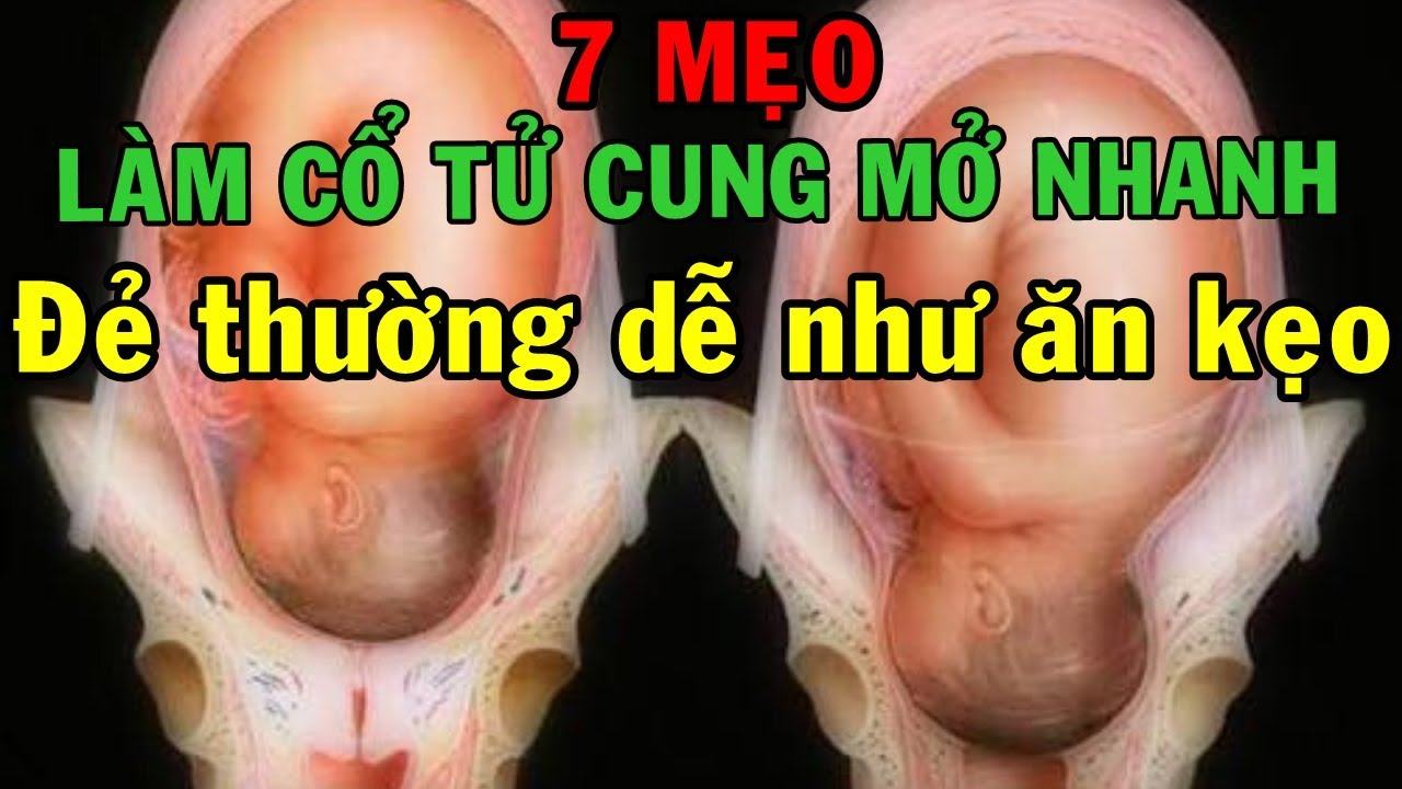 7 MẸO KHIẾN CỔ TỬ CUNG MỞ NHANH, ĐẺ THƯỜNG DỄ NHƯ ĂN KẸO