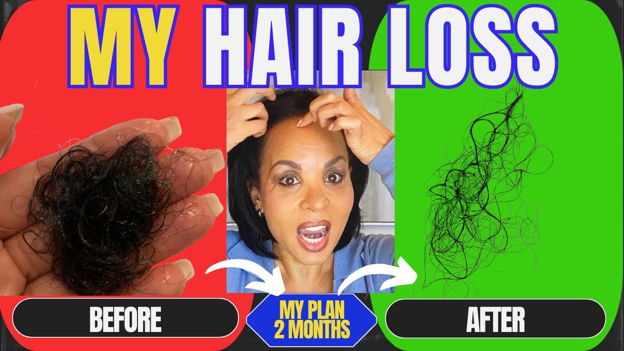 6 Steps to Regrow Hair…the “Rolls Royce” of Hair Restoration