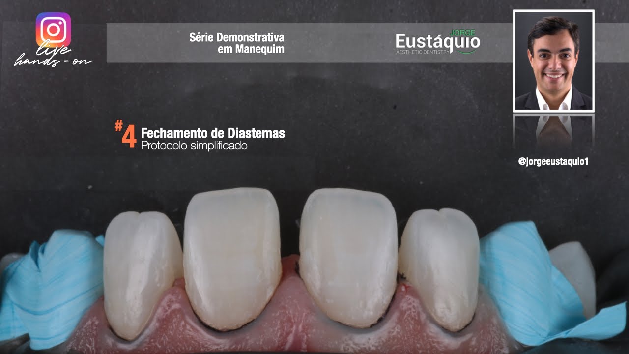 Live Hands-on - Fechamento de Diastemas