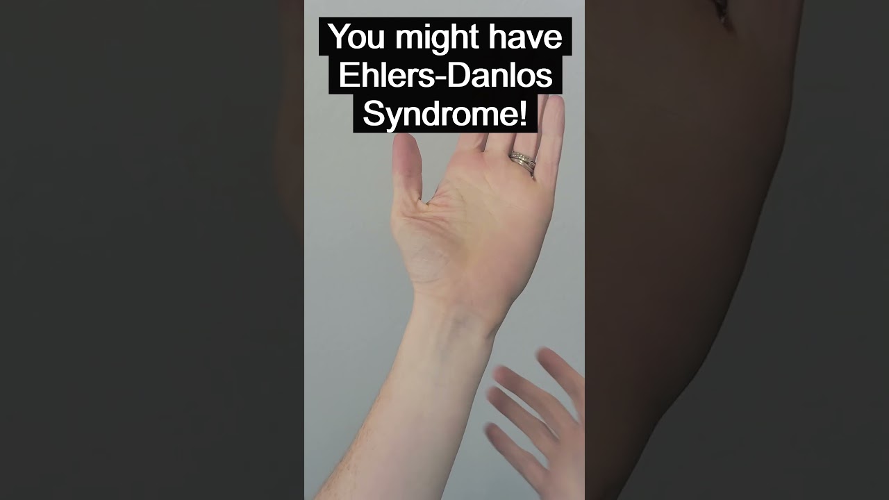 Do you have Arachnodactyly?