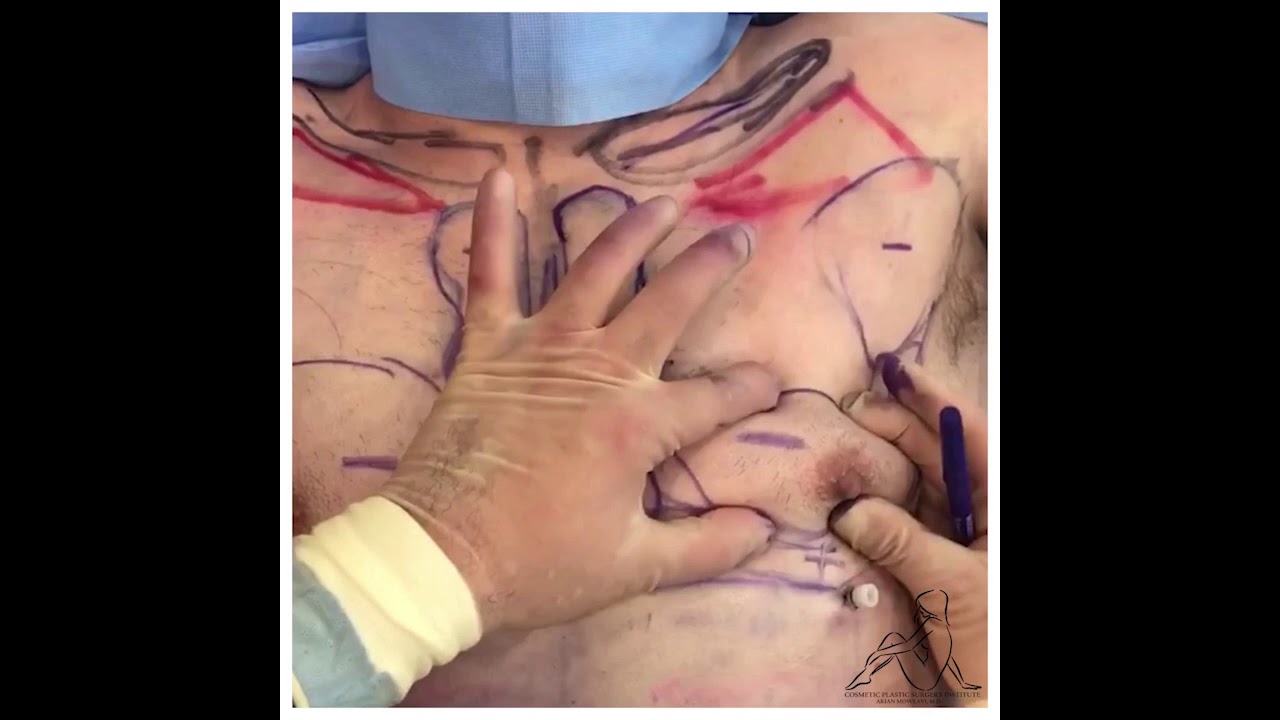 CHEST OPTIMIZATION HIGH DEFINITION LIPOSUCTION AND CHEST SHAVING WITH FAT GRAFTING