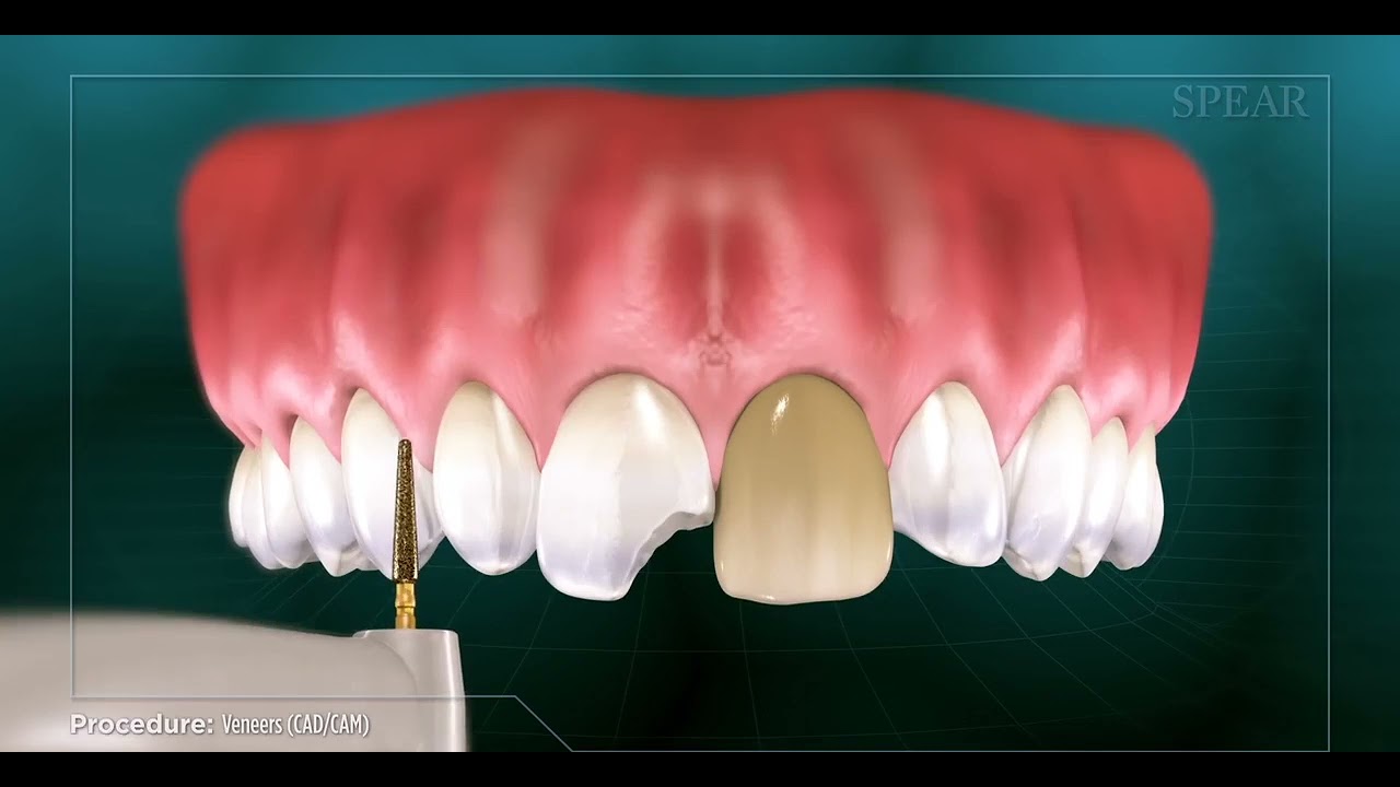 Veneers (CAD/CAM)