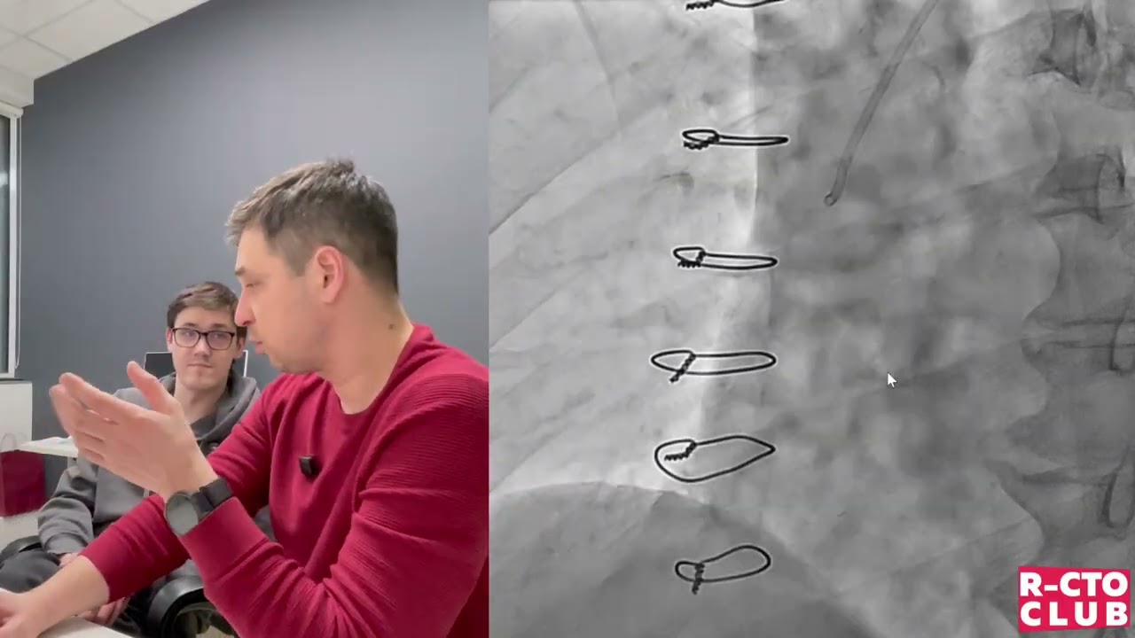 Midweek Post №5 🫀 Post CABG RCA CTO
