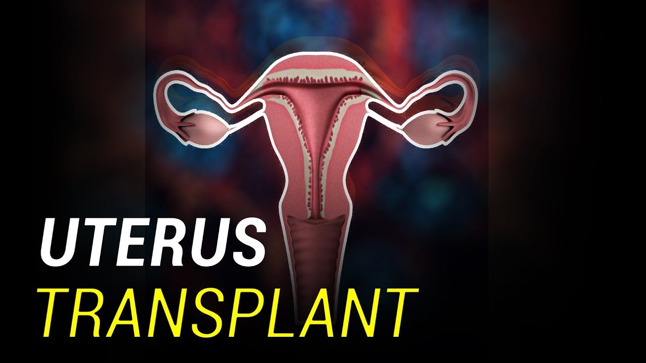 First baby born using Uterus Transplant from deceased donor