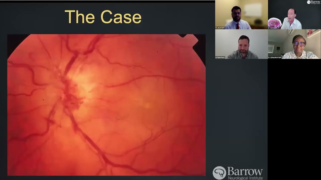 Lecture: Approach to the Patient With Unilateral Optic Disc Swelling