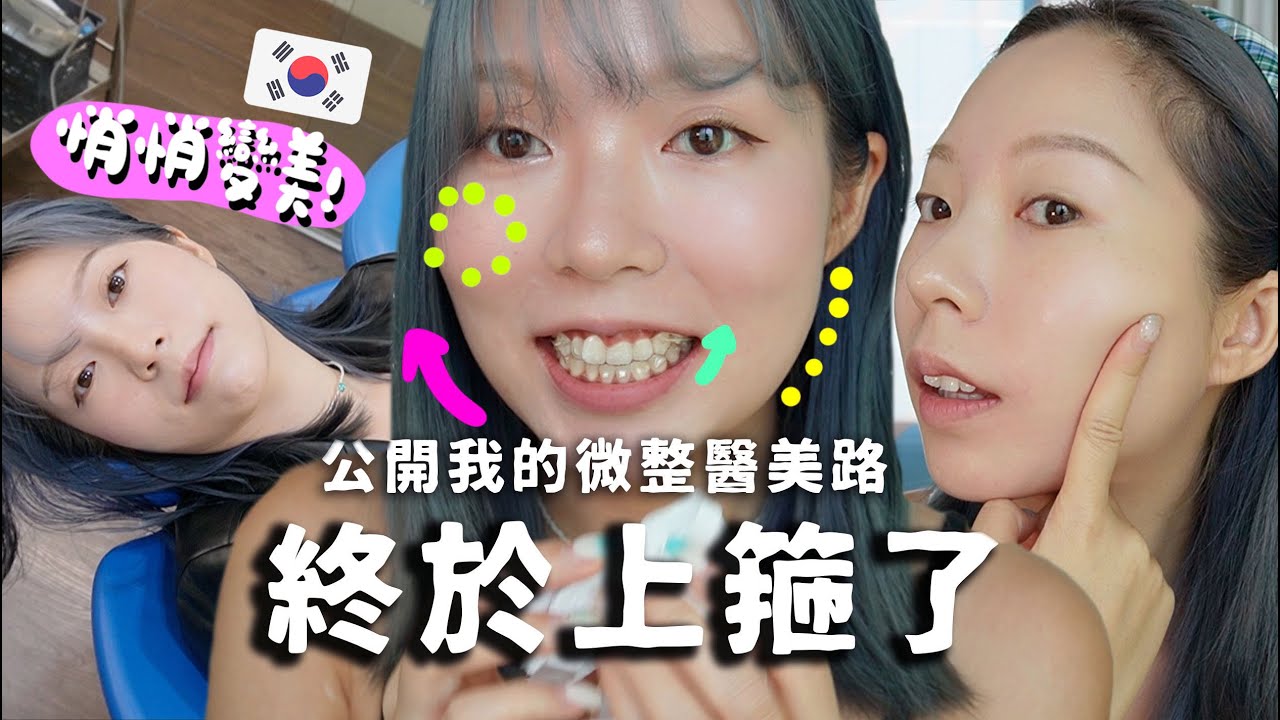 🦷上箍日終於變箍牙妹啦！把所有做過的醫美全公開！效果怎樣??痛嗎？終於悄悄變美了…動手腳大方承認！！ feat. medicube AGE-R Ussera