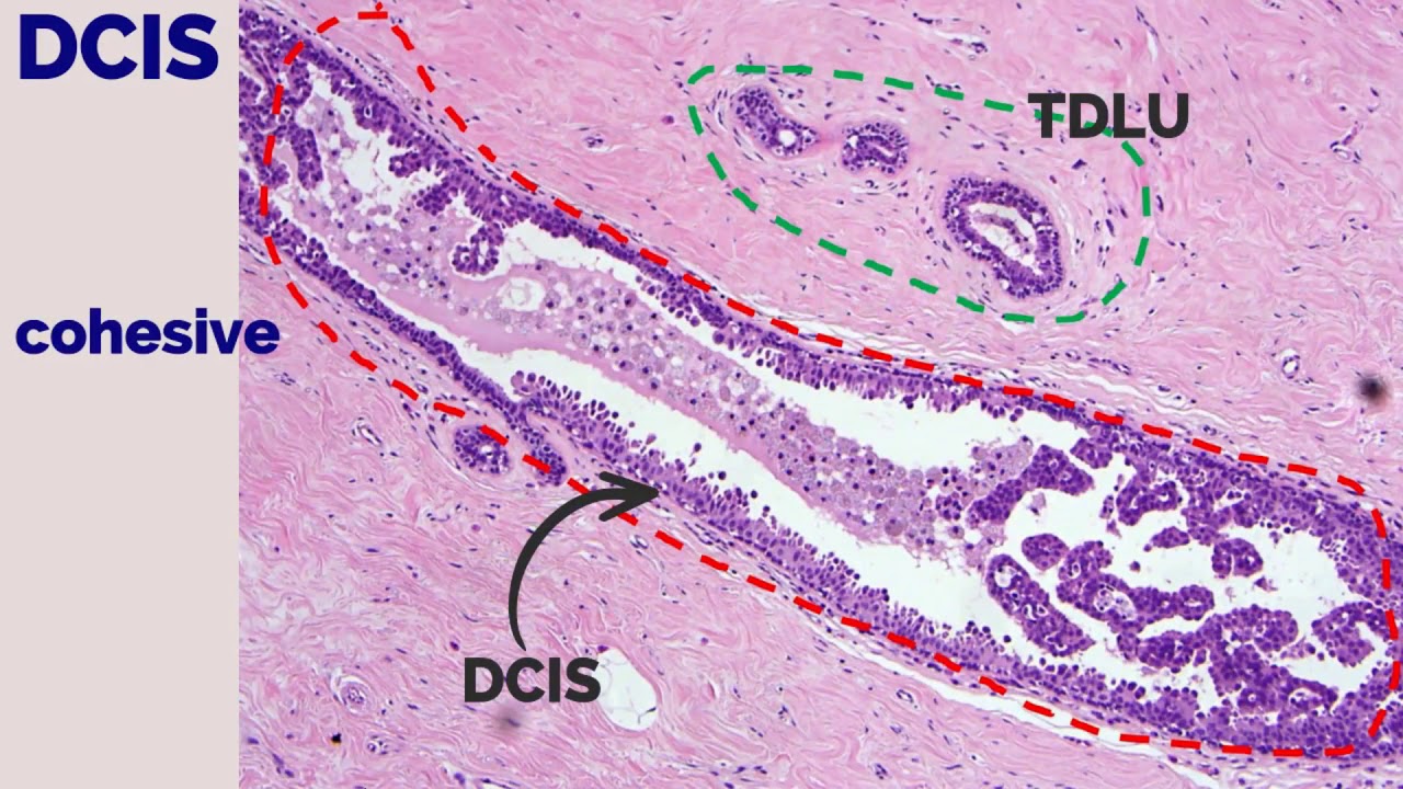 APGO Basic Sciences - Topic 7: Breast Disorders