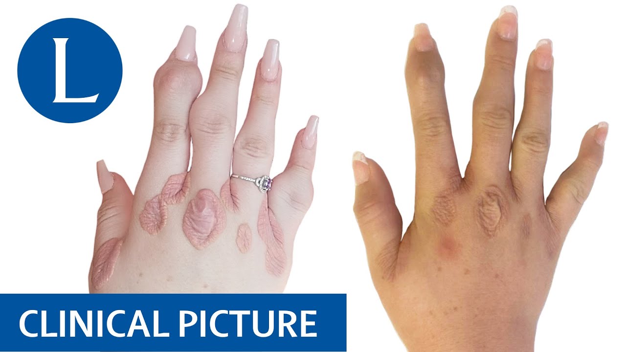 Homozygous familial hypercholesterolaemia: high risk of atherosclerotic cardiovascular disease