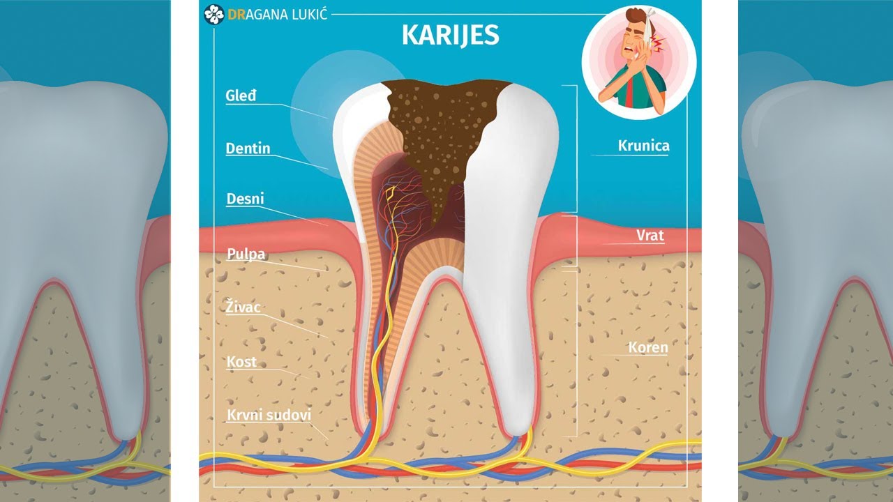 Karijes na zubu, nastanak i lečenje 🦷