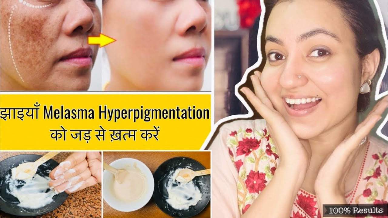 कितने भी मुश्किल झाइयाँ Hyperpigmentation Melasma काले धब्बे Spots हो, इस Remedy से होगा 100% इलाज |