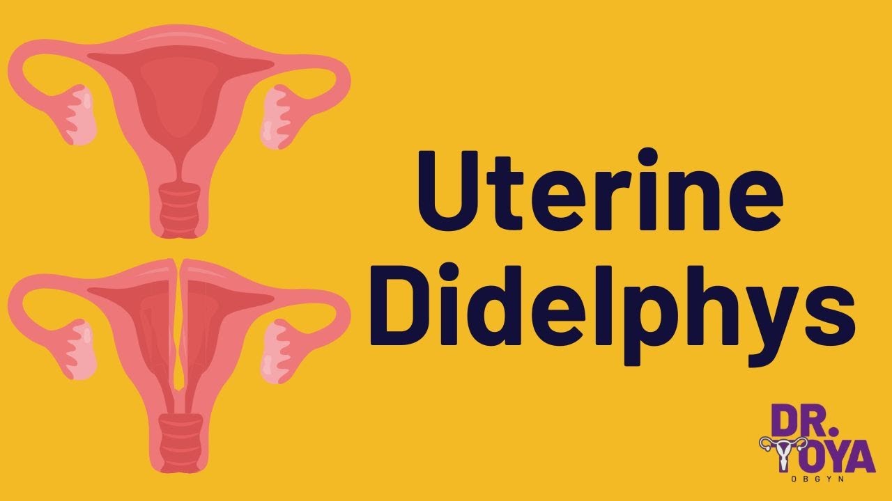 Uterine Didelphys