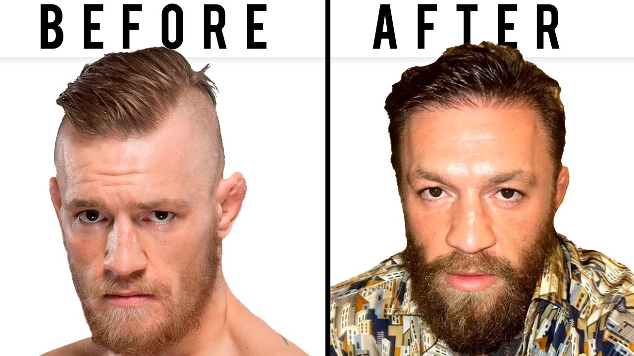 Conor McGregor's SECRET Hair Transplant | Plastic Surgery Analysis