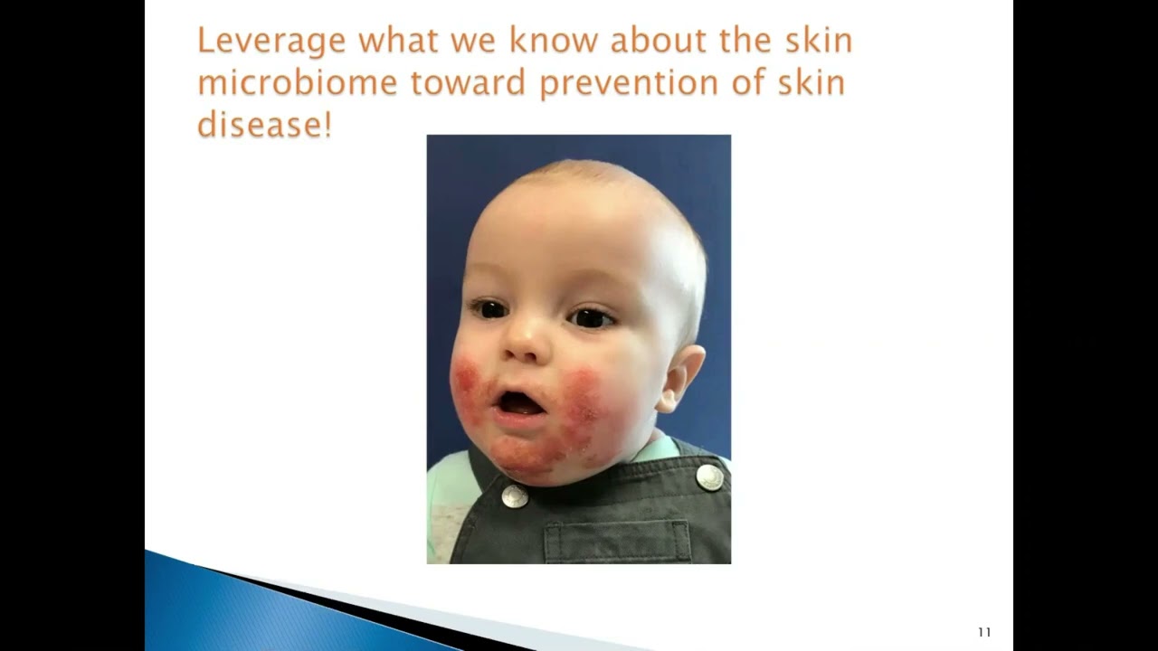 Publication Presentation: From the NICU to Eczema