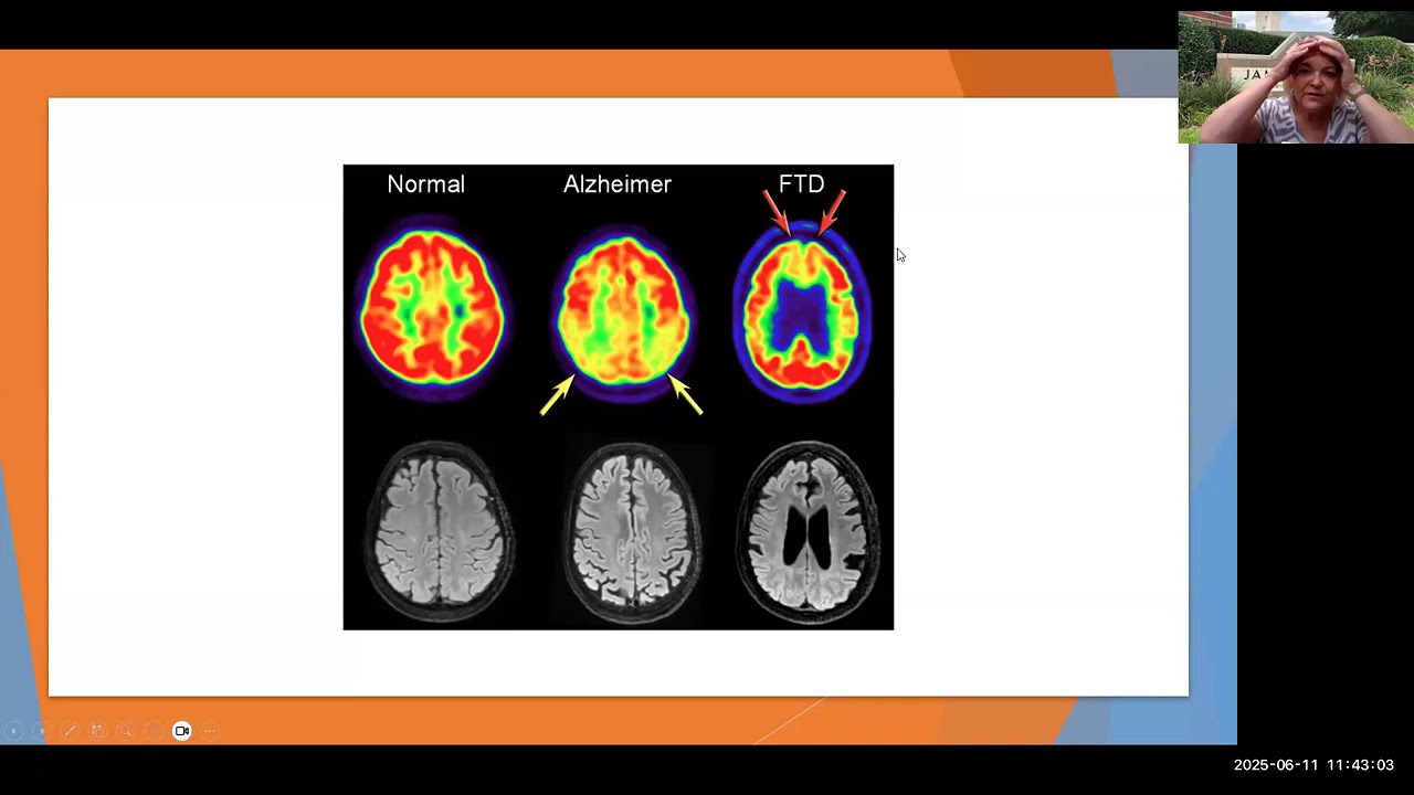 Understanding Frontotemporal Dementia