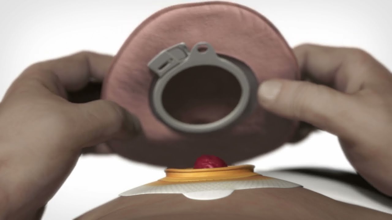 Aplicación del dispositivo de colostomía de 3 piezas