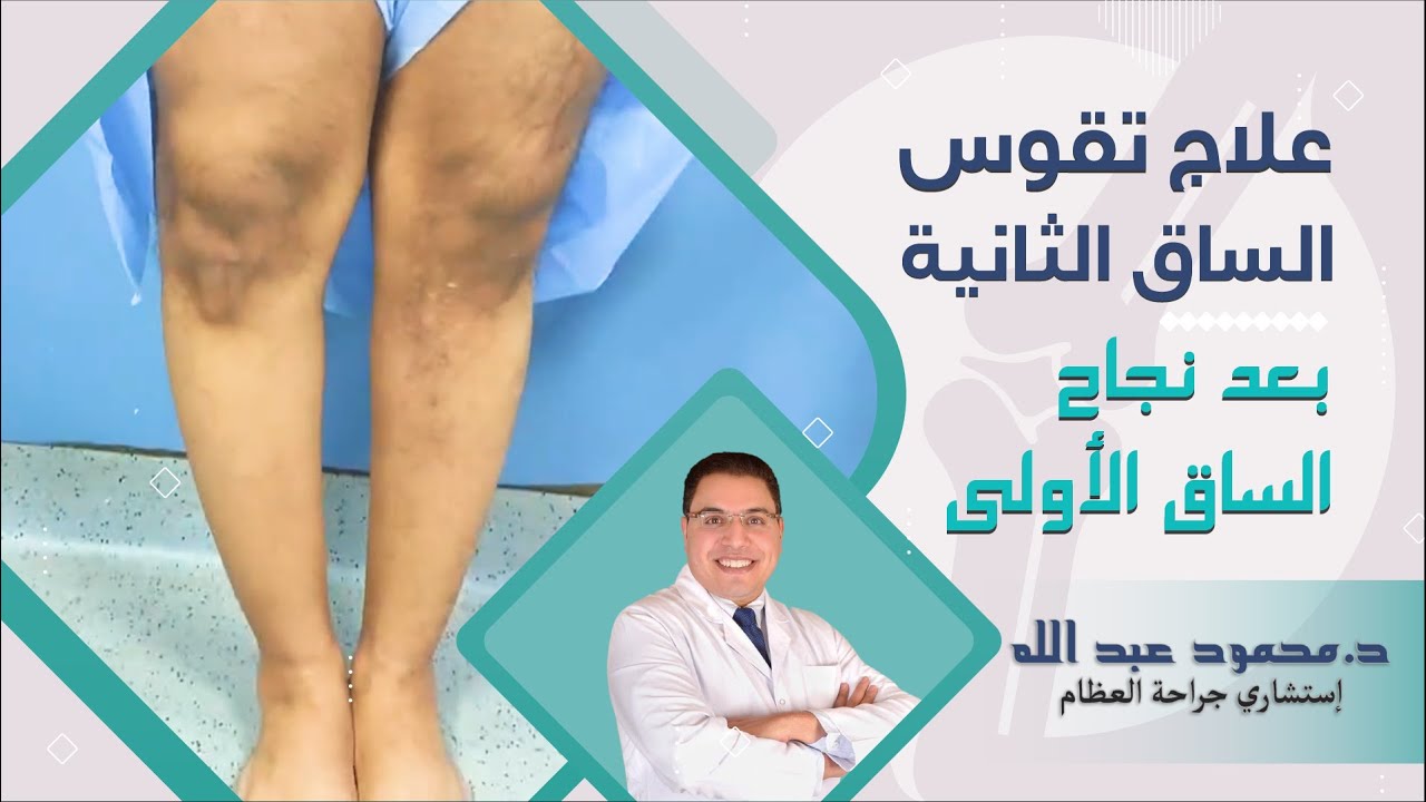 علاج تقوس الساق الثانية بعد نجاح الساق الأولى