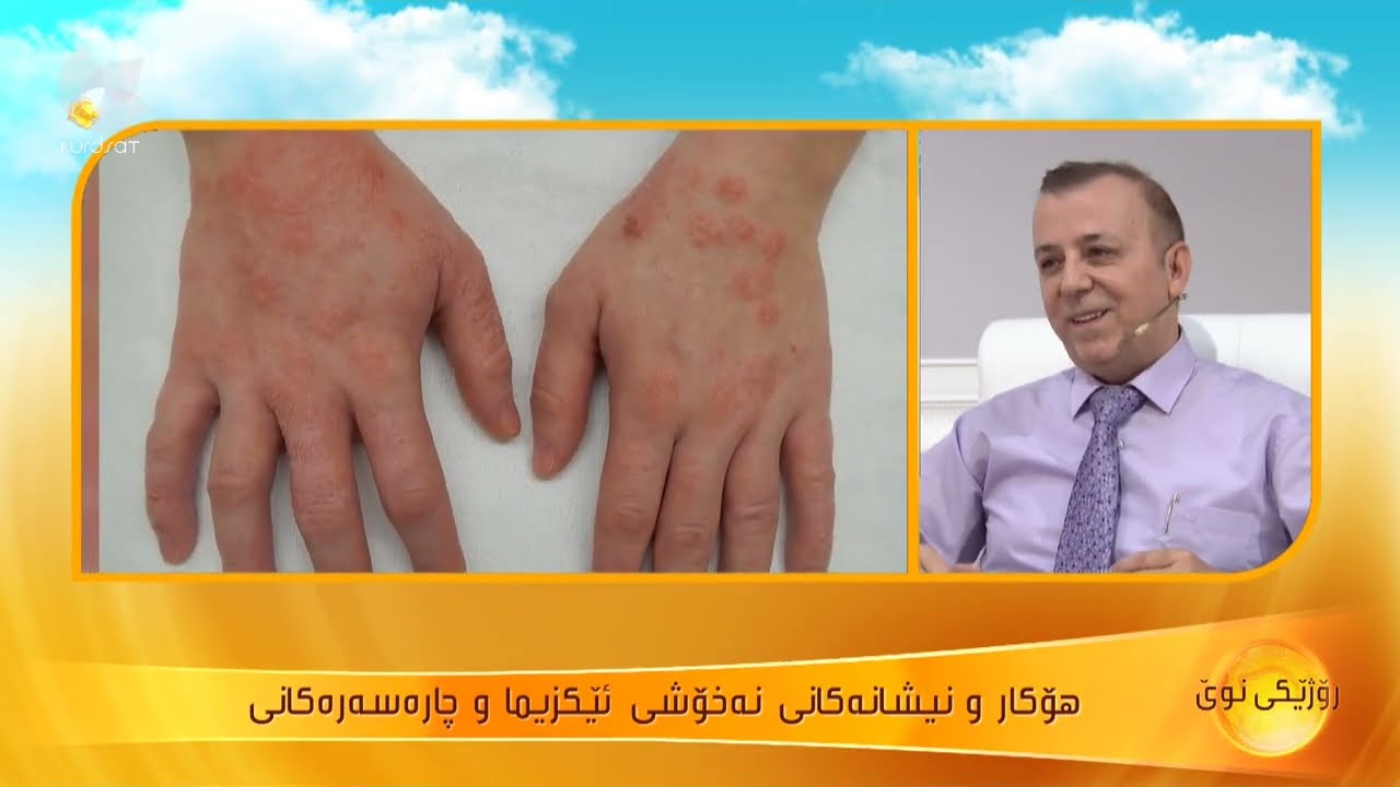 هۆكار و نیشانەكانی نەخۆشی ئێكزیما و چارەسەرەكانی ..د.بورهان تاهیر