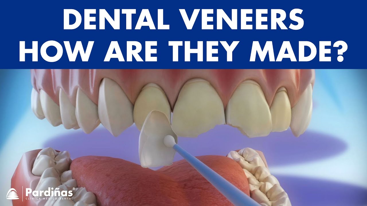 Veneers - How are they made? Preparation and placement of cosmetic dentistry veneers ©
