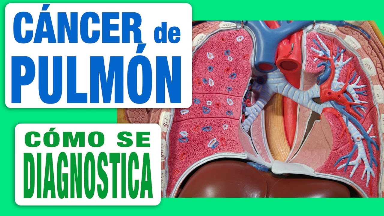 Cáncer de Pulmón - Diagnóstico
