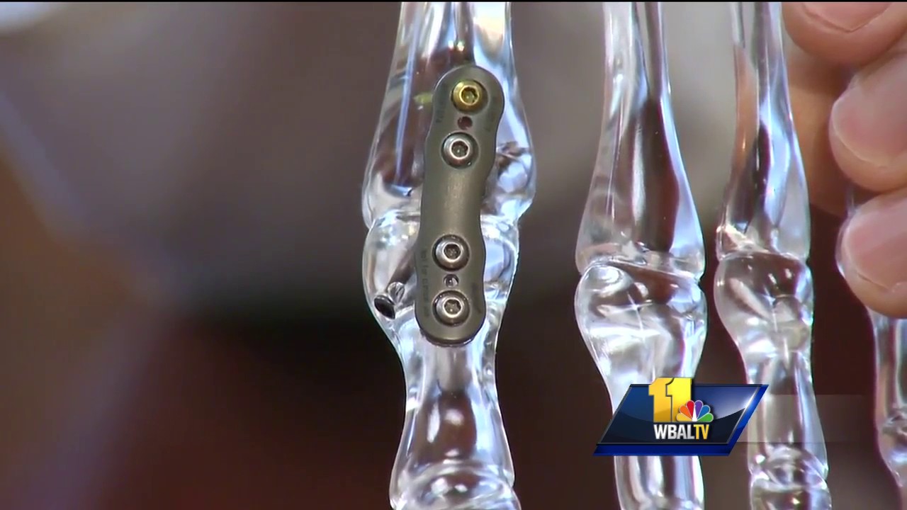Video: New procedure helps treat big toe arthritis