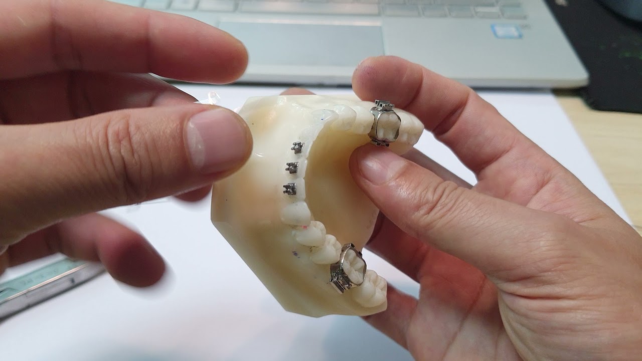 Cung kéo lui 4 răng cửa dưới
