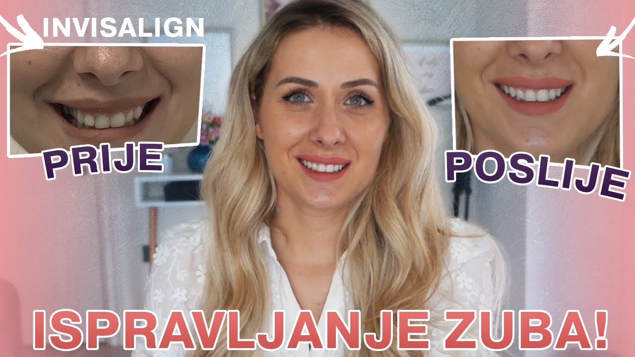 INVISALIGN FOLIJE ZA ISPRAVLJANJE ZUBA - MOJE ISKUSTVO