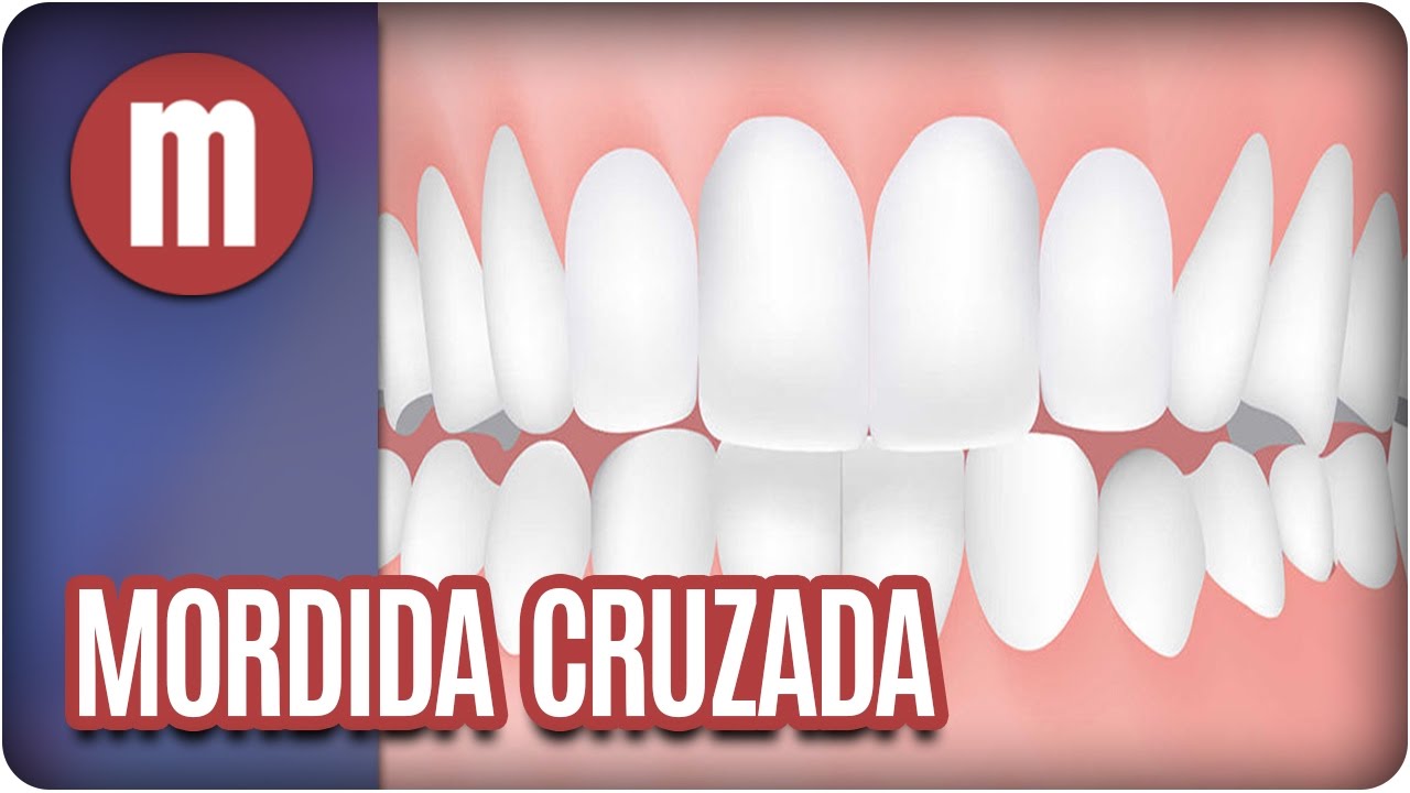 Saúde: mordida cruzada - Mulheres (17/04/17)