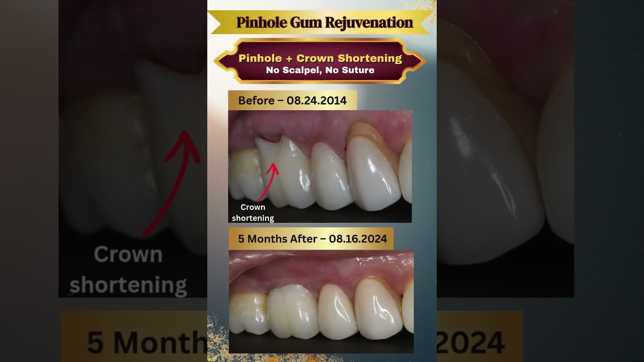 🤐Got A Long Crown? Check Out Our Crown Shortening Procedure With Pinhole Gum Rejuvenation&reg;!