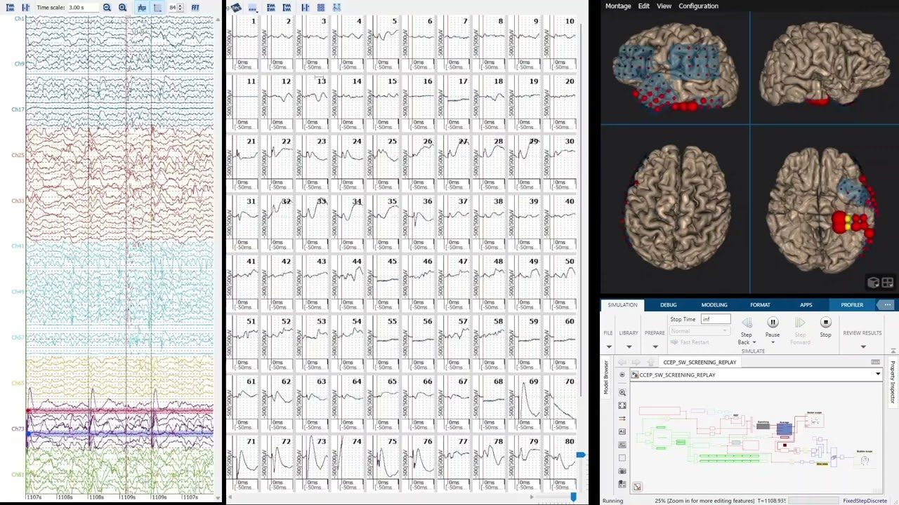 CCEP mapping with cortiQ rapid cortical mapping system
