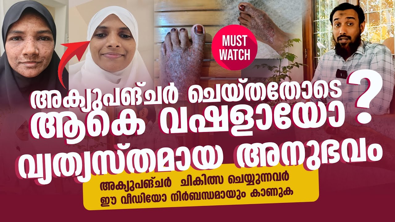 അക്യുപങ്ചർ ചെയ്തതോടെ ആകെ വഷളായോ ? വ്യത്യസ്തമായ അനുഭവം  | Acu.Pr. Shuhaib Riyaloo