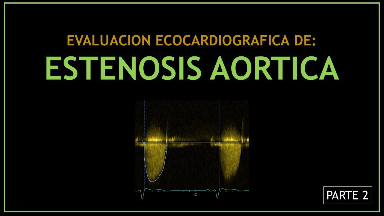 ESTENOSIS AORTICA (Evaluacion ecocardiografica) - PARTE 2