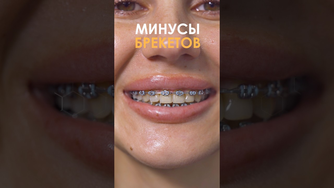 Брекеты с установкой и системой за 21.900 Элайнеры 149.990. Подробнее ТГ: 8969&rsquo;0004040